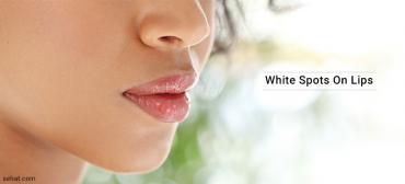 What Causes White Spots On Lips And How To Get Rid?