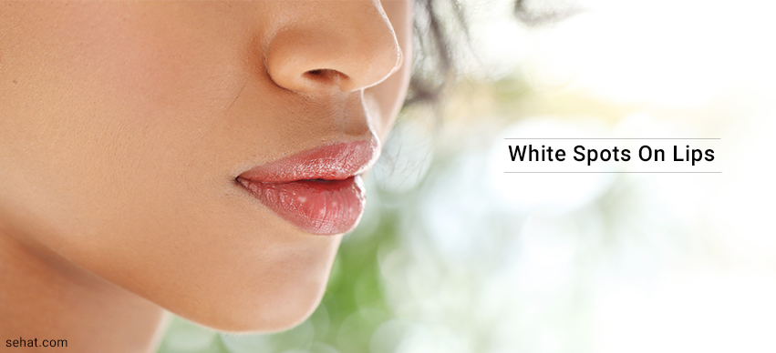 What Causes White Spots On Lips And How To Get Rid?