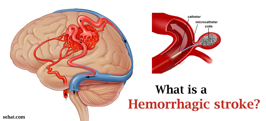 Hemorrhagic stroke: Causes, Symptoms, Prognosis and Treatment