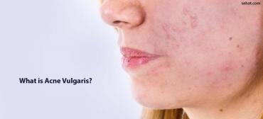 What Is Acne Vulgaris? - Causes And Treatment