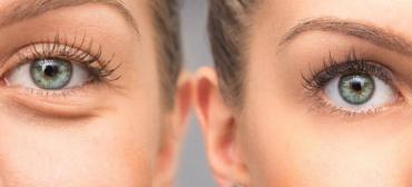 What is the Best Eye Swelling Treatment?