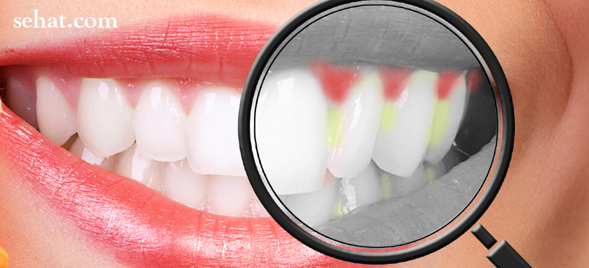 What You Should Know about Gingivitis?