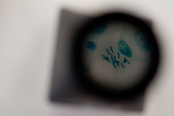 Delamanid may be beneficial as an add-on therapy to the standard treatment regimen of multidrug resistant tuberculosis